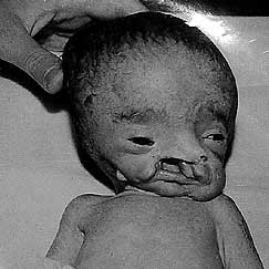 Depleted Uranium & Phosphorous: Massive Deformitites of Fallujah Babies ...