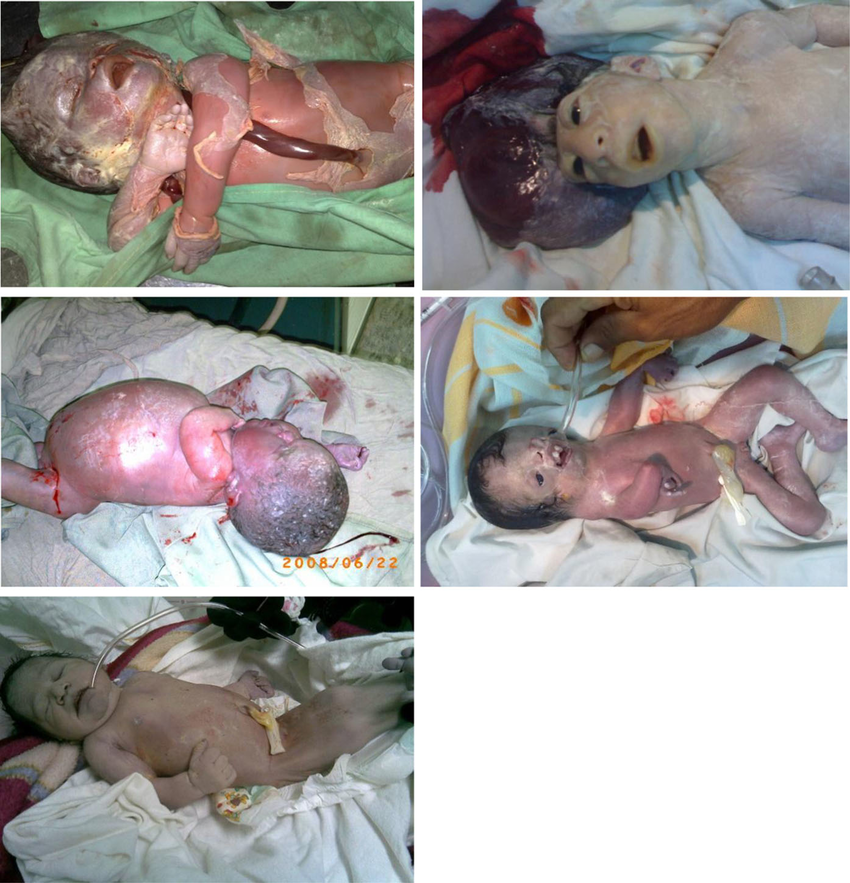 Selected photos of children born in Fallujah between 2008 and 2010, showing severe neurodevelopmental disorders, in the form of multiple birth defects